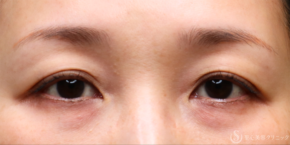 【40代女性・目の下の膨らみ改善】目の下の脂肪取り（1年1ヶ月後） Before 名古屋+目の下のくまとり・目の下のくま・たるみ