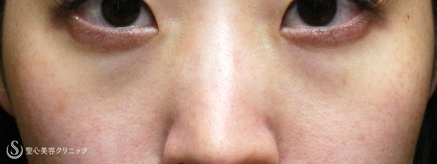 【20代女性・本当に「裏ハムラ」必要ですか？】経結膜下脱脂術 単独（1ヶ月後） Before 