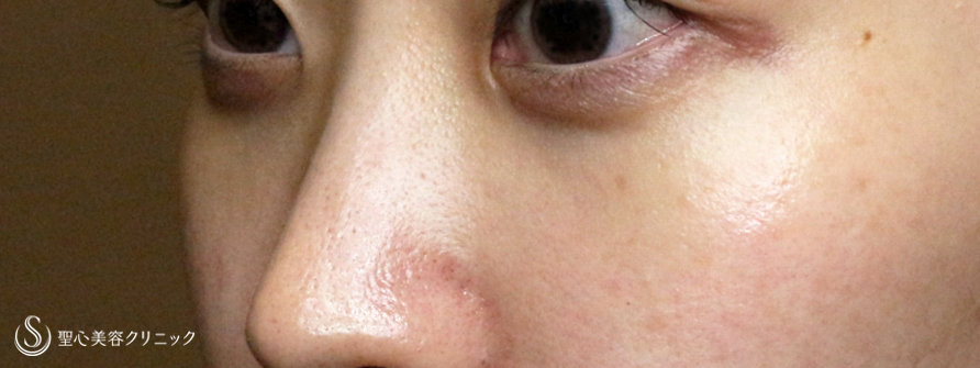 【20代女性・本当に「裏ハムラ」必要ですか？】経結膜下脱脂術 単独（1ヶ月後） After 
