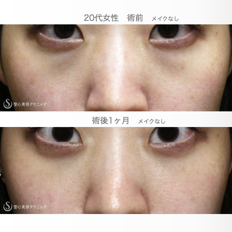 【20代女性・本当に「裏ハムラ」必要ですか？】経結膜下脱脂術 単独（1ヶ月後） After 