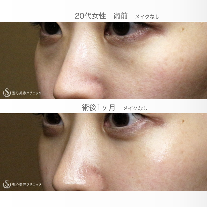 【20代女性・本当に「裏ハムラ」必要ですか？】経結膜下脱脂術 単独（1ヶ月後） After 
