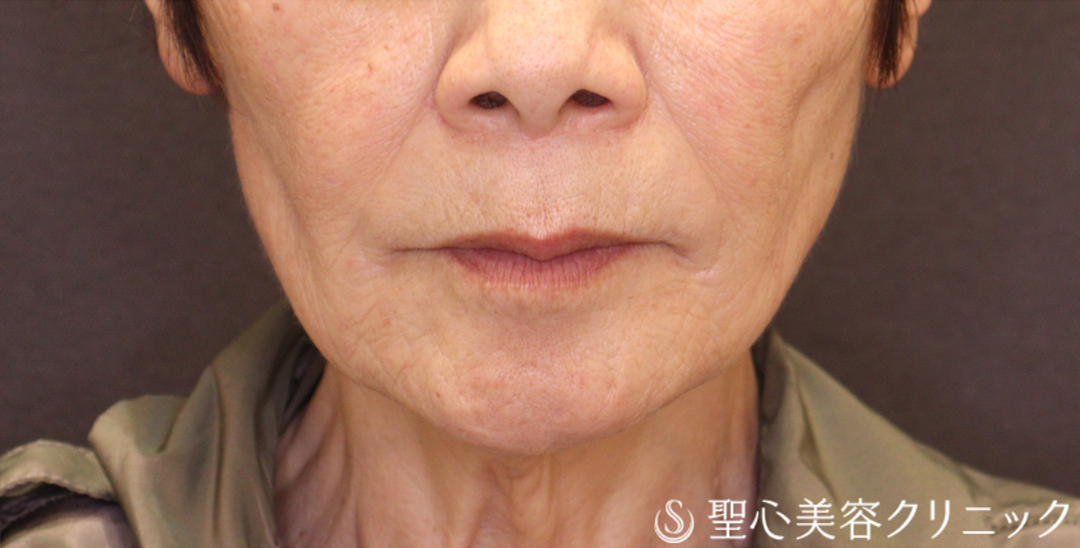 【70代女性・ヒアルロン酸注入 小じわの改善で自然に若返る】トータルフェイシャルトリートメント＋ボトックス注入（1ヶ月後） After 