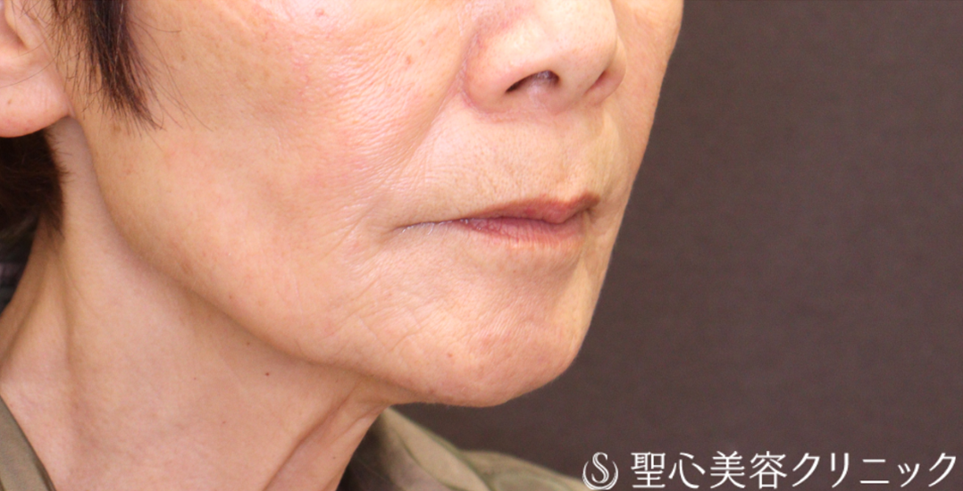 【70代女性・ヒアルロン酸注入 小じわの改善で自然に若返る】トータルフェイシャルトリートメント＋ボトックス注入（1ヶ月後） After 
