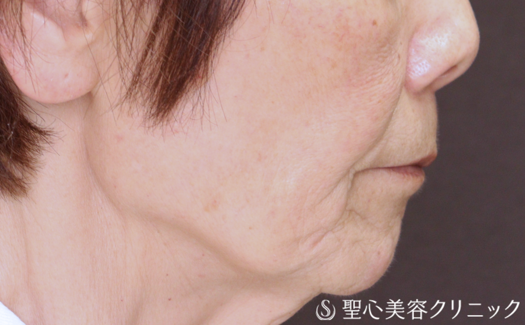 【70代女性・ヒアルロン酸注入 小じわの改善で自然に若返る】トータルフェイシャルトリートメント＋ボトックス注入（1ヶ月後） Before 