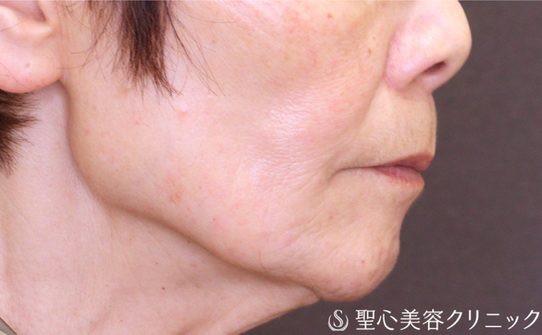 【70代女性・ヒアルロン酸注入 小じわの改善で自然に若返る】トータルフェイシャルトリートメント＋ボトックス注入（1ヶ月後） After 