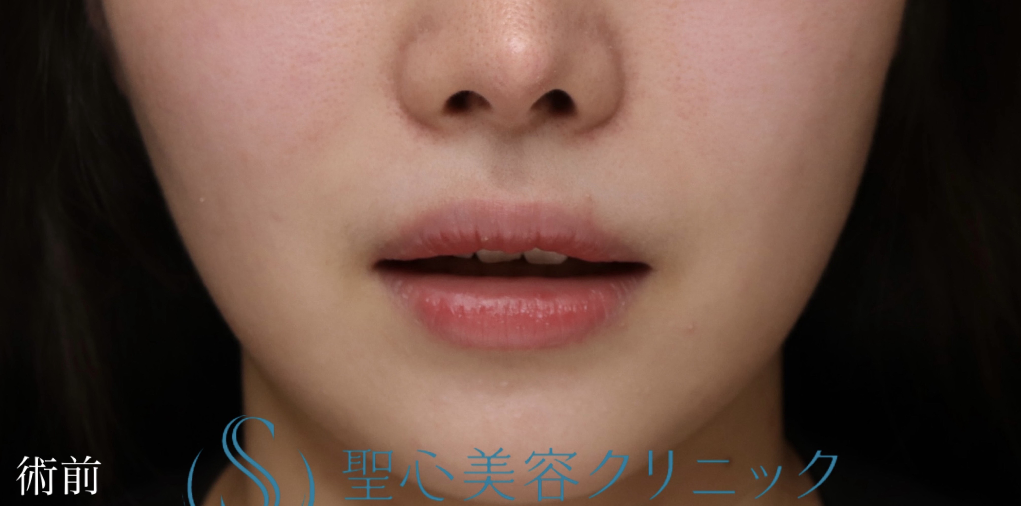 【20代女性・口元のバランスを可愛く整えたい！！】プレミアムリップリフト（プレミアム人中短縮術）（1週間後・抜糸時） Before 