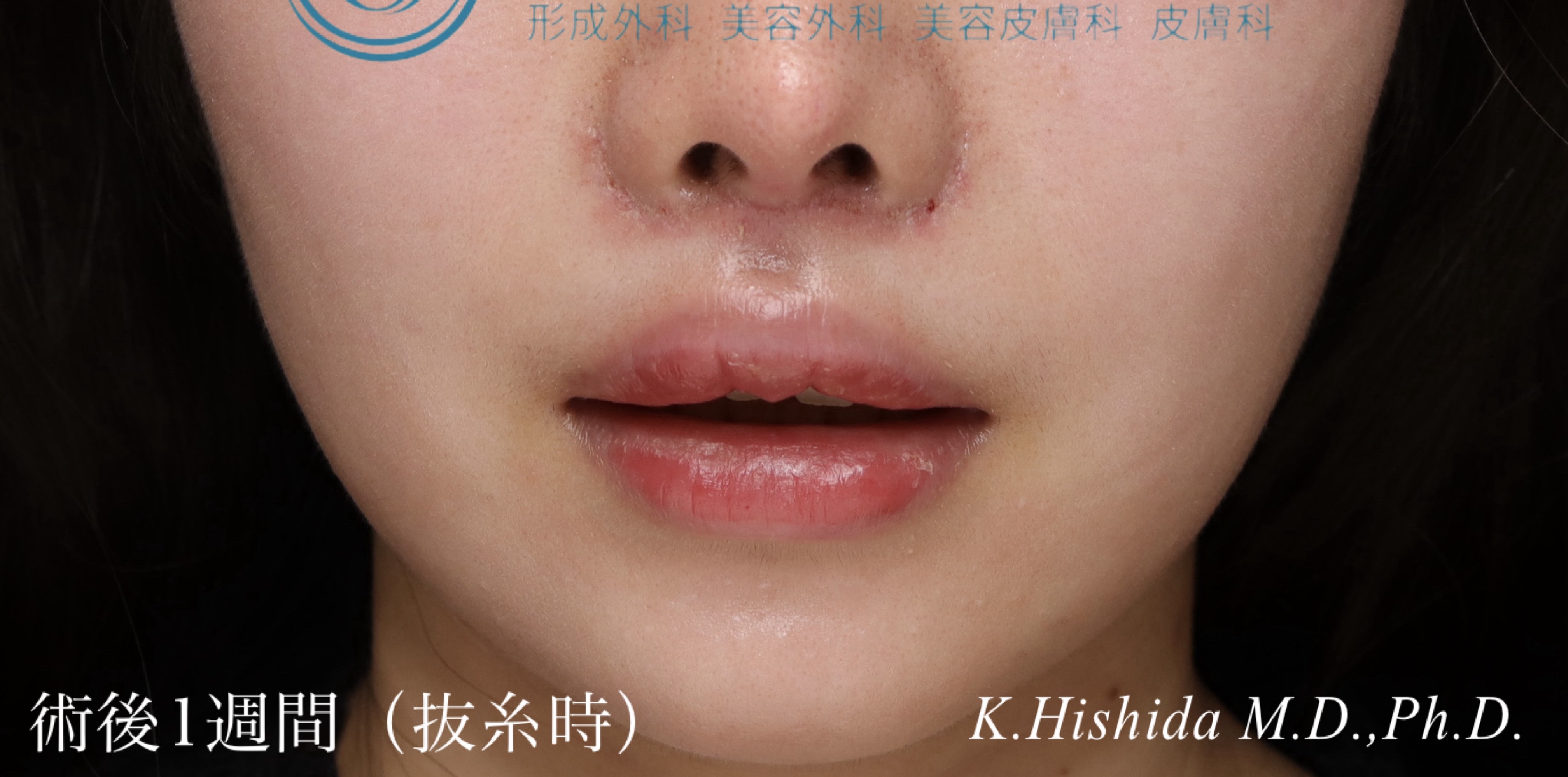 【20代女性・口元のバランスを可愛く整えたい！！】プレミアムリップリフト（プレミアム人中短縮術）（1週間後・抜糸時） After 