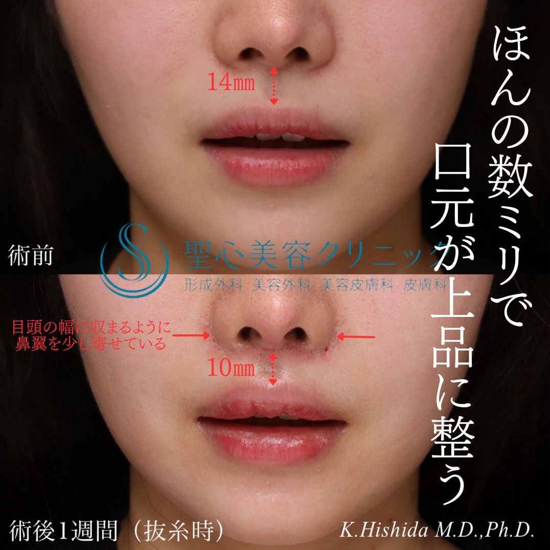 【20代女性・口元のバランスを可愛く整えたい！！】プレミアムリップリフト（プレミアム人中短縮術）（1週間後・抜糸時） After 