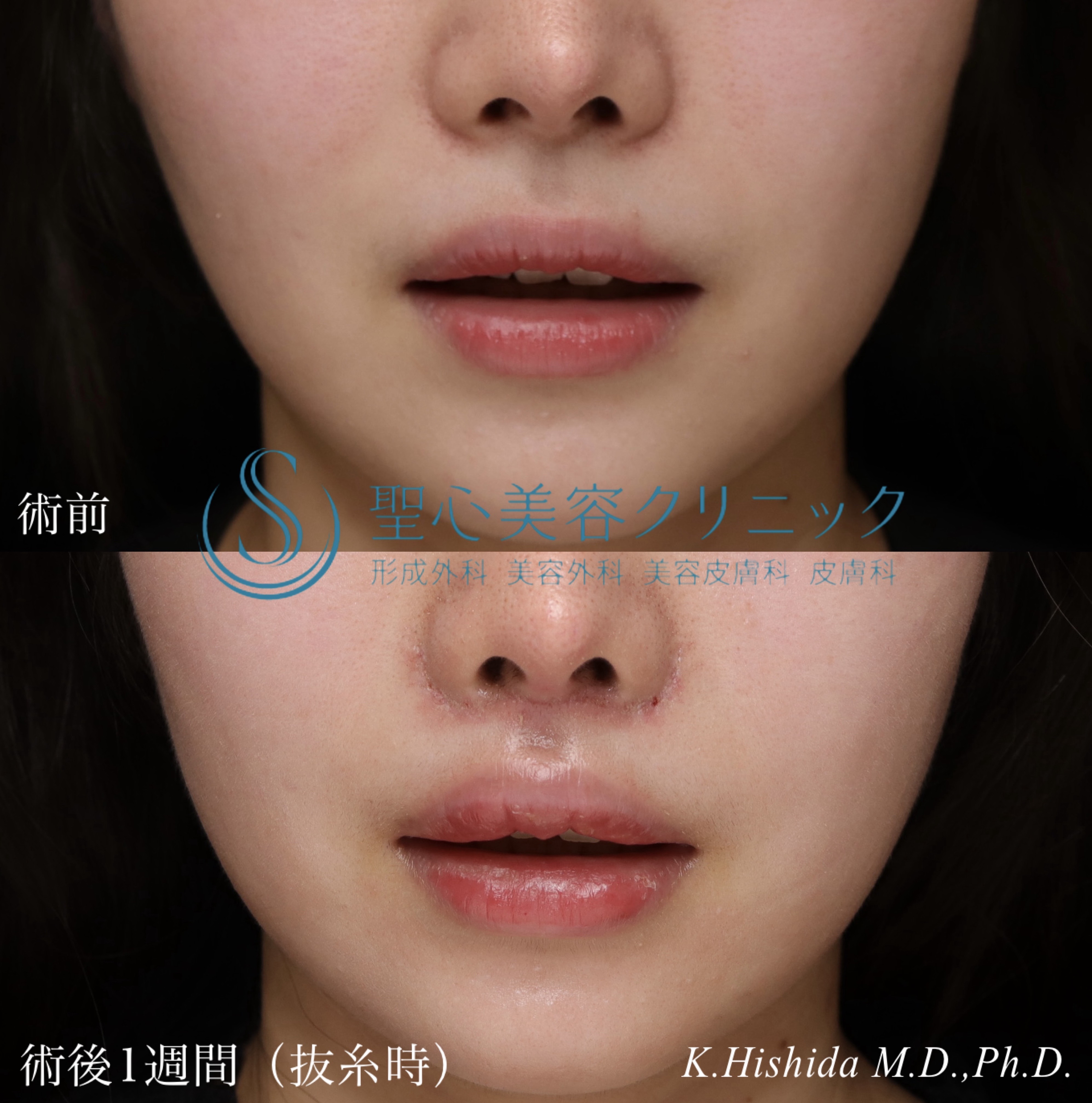 【20代女性・口元のバランスを可愛く整えたい！！】プレミアムリップリフト（プレミアム人中短縮術）（1週間後・抜糸時） After 