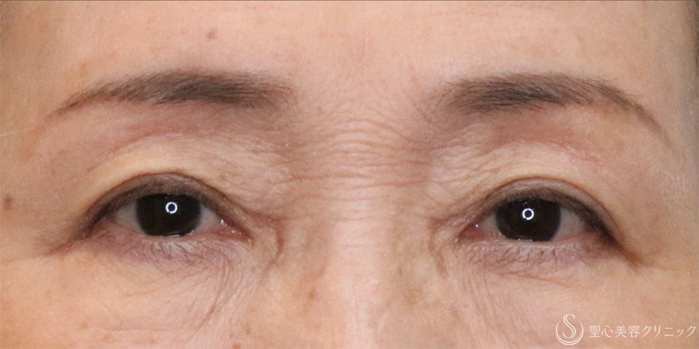 【70代女性・お目元の若返り】眉下切開法＋目上切開法＋二重埋没法（マイクロメソッド＋α）（2ヶ月後） After 名古屋+まぶたのタルミ取り・二重・ぱっちり二重・眉下切開