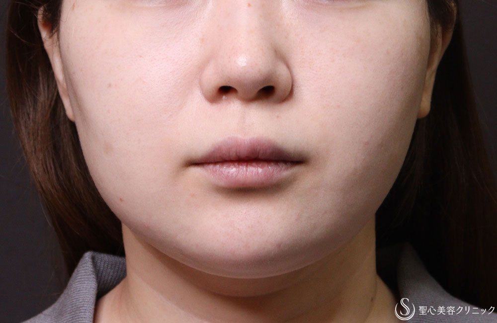 【30代女性・小顔】エラボトックス＋FatX Core 脂肪溶解注射（頬）（3ヶ月後） Before 