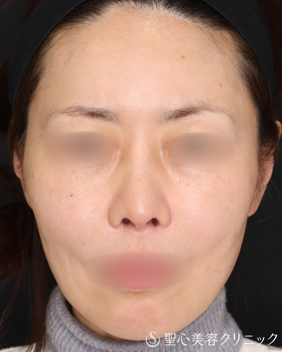 【40代女性・鼻先を整えてすっきりと】鼻尖形成＋鼻尖縮小術（3ヶ月後） Before 