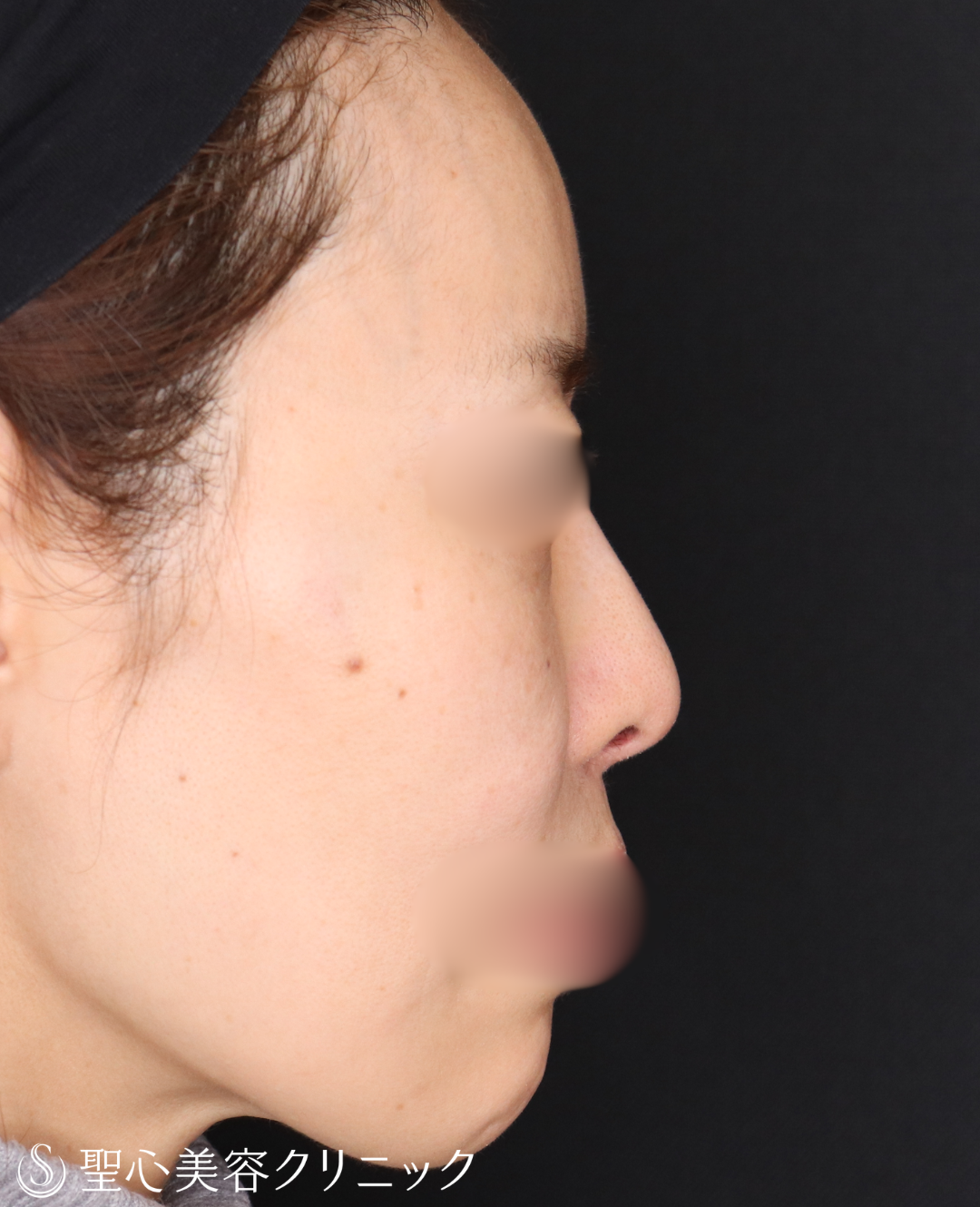 【40代女性・鼻先を整えてすっきりと】鼻尖形成＋鼻尖縮小術（3ヶ月後） Before 