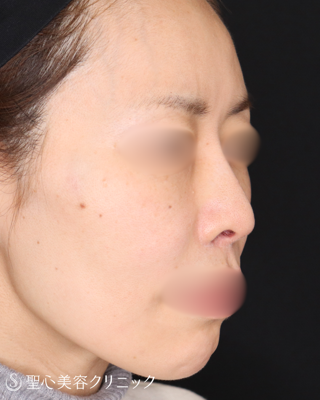 【40代女性・鼻先を整えてすっきりと】鼻尖形成＋鼻尖縮小術（3ヶ月後） Before 