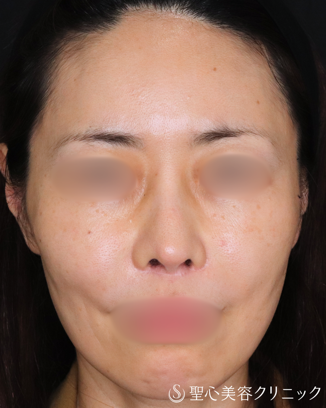 【40代女性・鼻先を整えてすっきりと】鼻尖形成＋鼻尖縮小術（3ヶ月後） After 