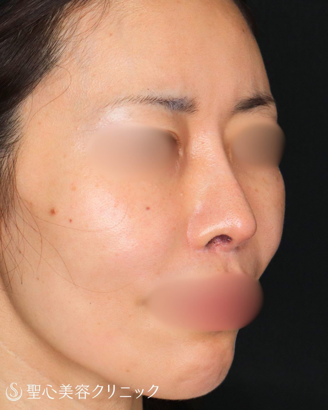 【40代女性・鼻先を整えてすっきりと】鼻尖形成＋鼻尖縮小術（3ヶ月後） After 