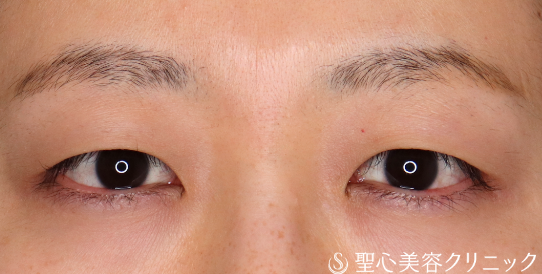 【20代女性・瞼の重さをとってすっきりとした二重に】二重切開法＋眼窩脱脂（3ヶ月後） Before 