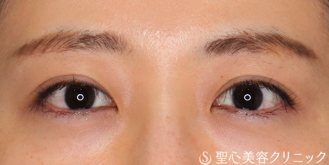 【20代女性・瞼の重さをとってすっきりとした二重に】二重切開法＋眼窩脱脂（3ヶ月後） After 