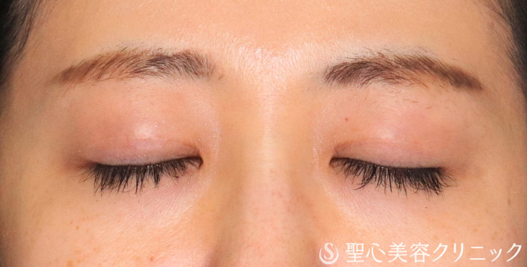 【20代女性・瞼の重さをとってすっきりとした二重に】二重切開法＋眼窩脱脂（3ヶ月後） After 
