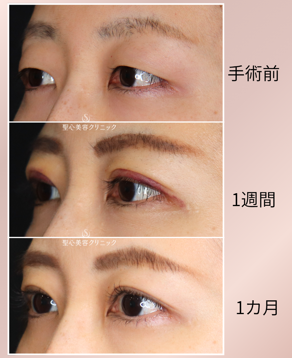 【20代女性・瞼の重さをとってすっきりとした二重に】二重切開法＋眼窩脱脂（3ヶ月後） After 