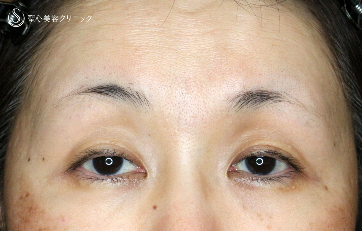 【50代女性・ハードコンタクトレンズ眼瞼下垂】切らない眼瞼下垂+α法（術直後） Before 