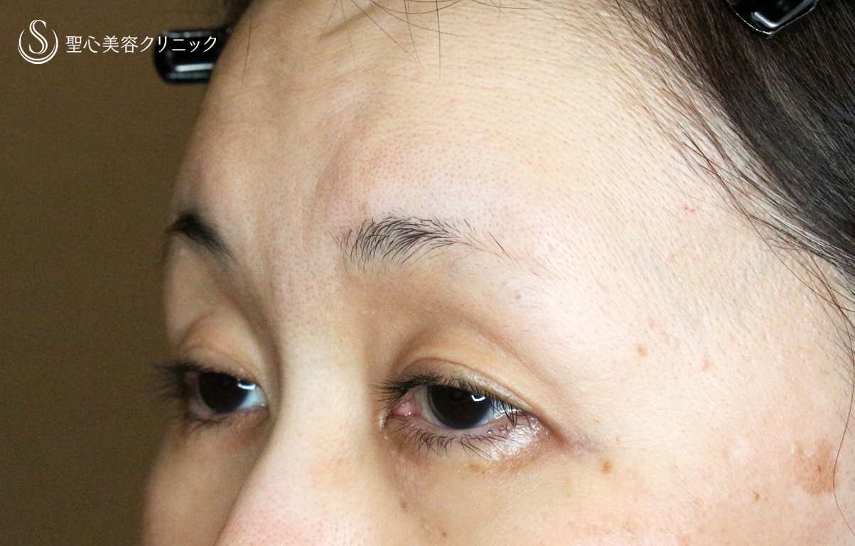 【50代女性・ハードコンタクトレンズ眼瞼下垂】切らない眼瞼下垂+α法（術直後） Before 