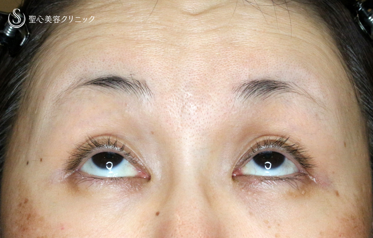 【50代女性・ハードコンタクトレンズ眼瞼下垂】切らない眼瞼下垂+α法（術直後） Before 