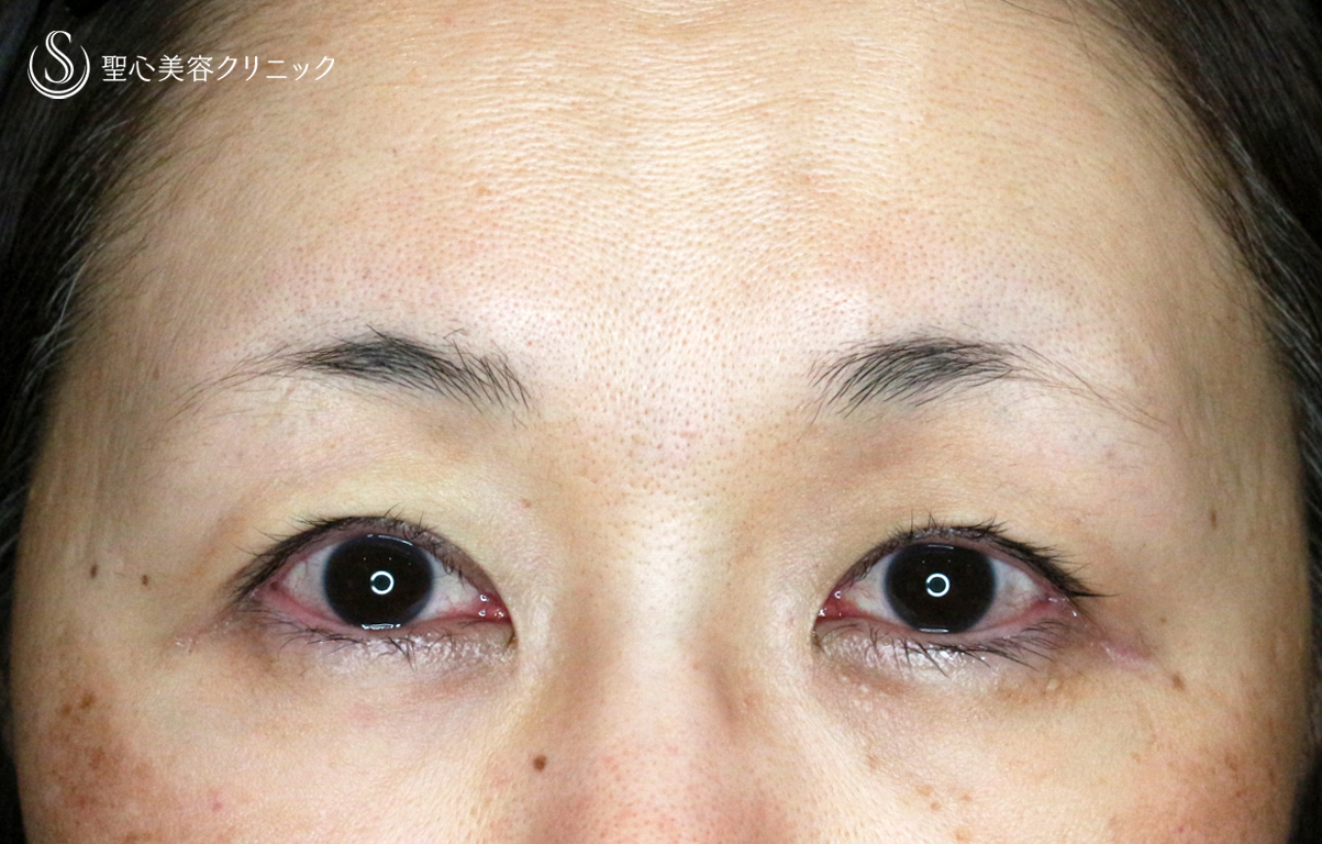 【50代女性・ハードコンタクトレンズ眼瞼下垂】切らない眼瞼下垂+α法（術直後） After 