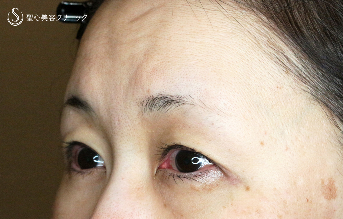 【50代女性・ハードコンタクトレンズ眼瞼下垂】切らない眼瞼下垂+α法（術直後） After 