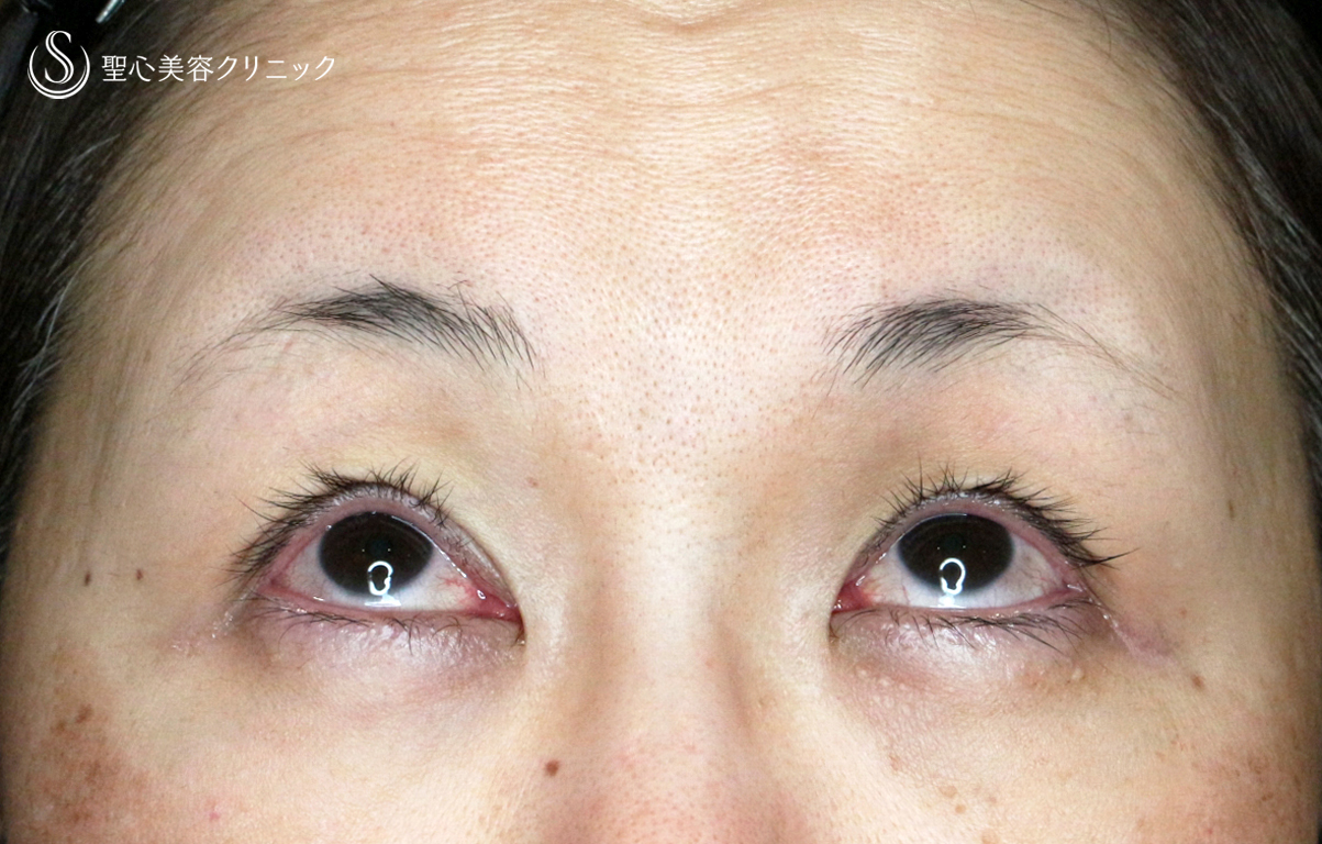 【50代女性・ハードコンタクトレンズ眼瞼下垂】切らない眼瞼下垂+α法（術直後） After 