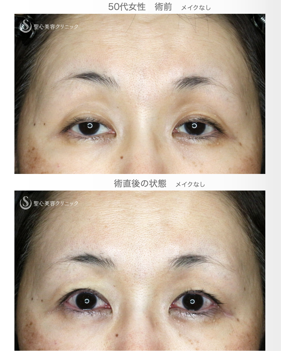 【50代女性・ハードコンタクトレンズ眼瞼下垂】切らない眼瞼下垂+α法（術直後） After 