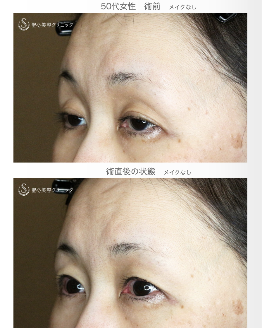 【50代女性・ハードコンタクトレンズ眼瞼下垂】切らない眼瞼下垂+α法（術直後） After 
