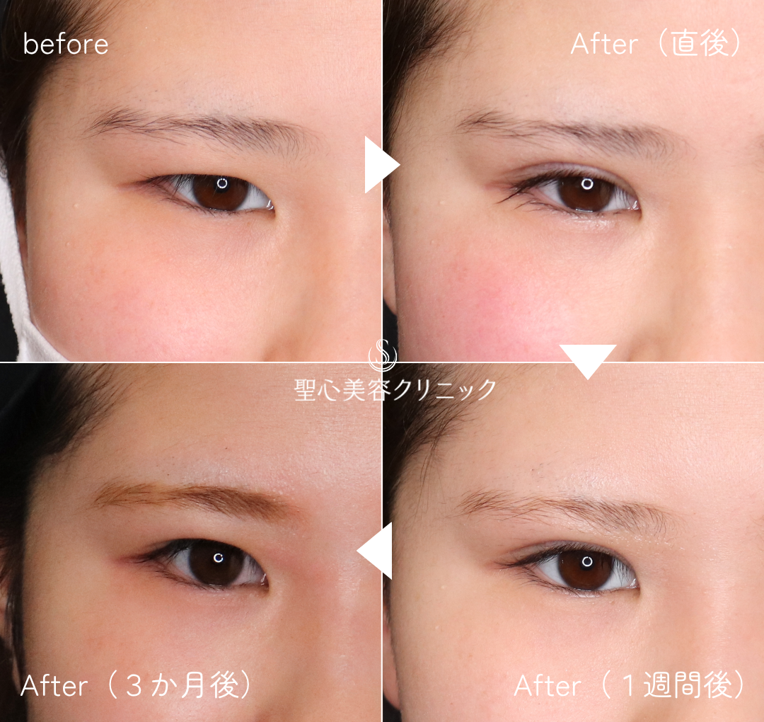 【10代女性・自然な二重に】マイクロメソッド+α法　3点留め（3ヶ月後） After 