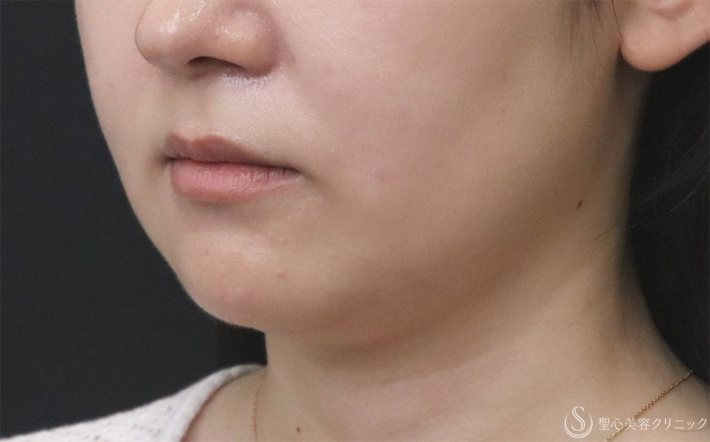【30代女性・フェイスラインをすっきり】FATx Core（脂肪溶解注射）顎下（1ヶ月後） Before 