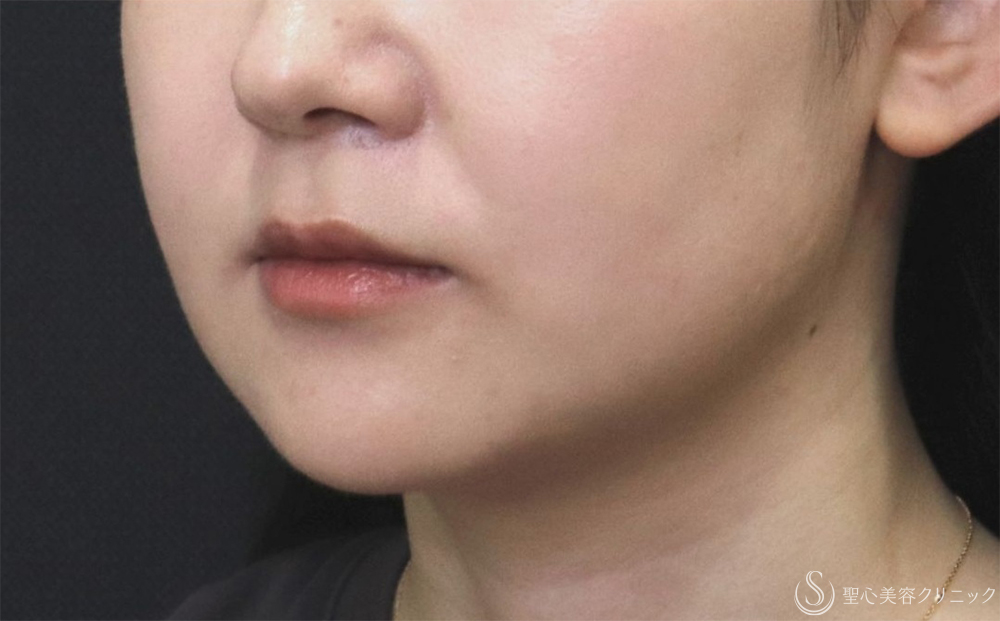 【30代女性・フェイスラインをすっきり】FATx Core（脂肪溶解注射）顎下（1ヶ月後） After 