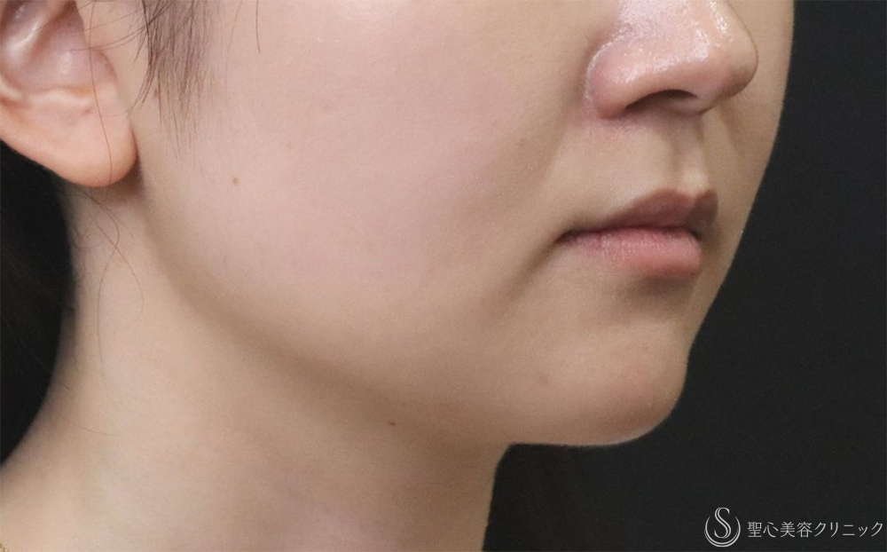 【30代女性・フェイスラインをすっきり】FATx Core（脂肪溶解注射）顎下（1ヶ月後） Before 