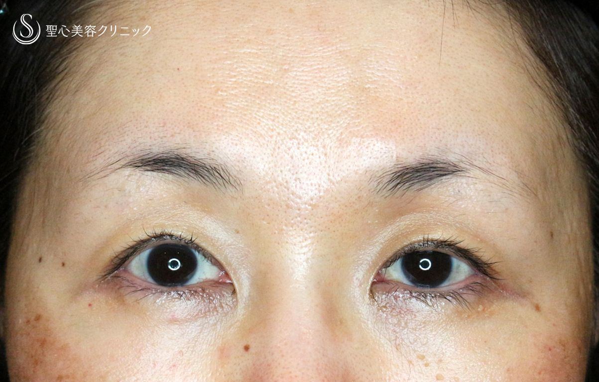 【50代女性・ハードコンタクトレンズ眼瞼下垂】切らない眼瞼下垂+α法（術直後〜1ヶ月後） After 