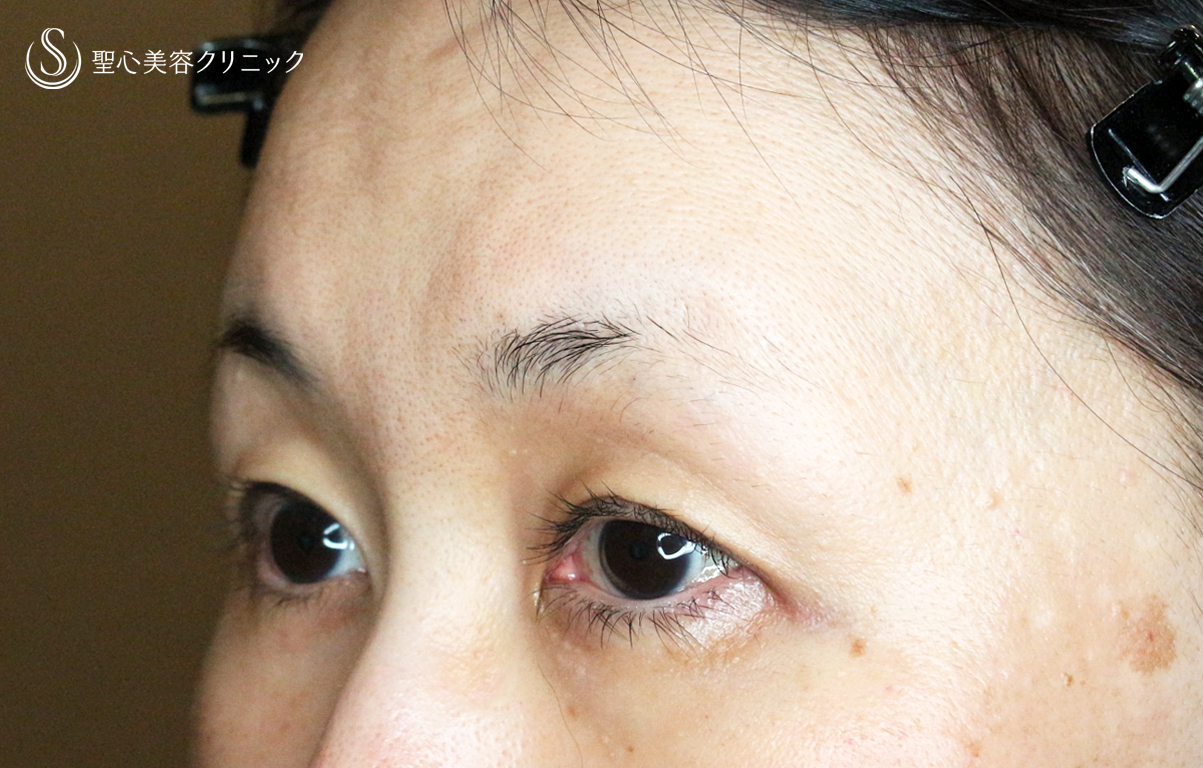 【50代女性・ハードコンタクトレンズ眼瞼下垂】切らない眼瞼下垂+α法（術直後〜1ヶ月後） After 