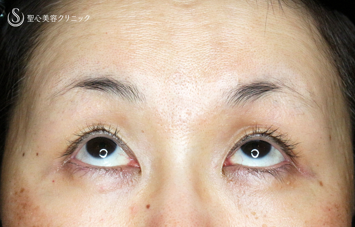【50代女性・ハードコンタクトレンズ眼瞼下垂】切らない眼瞼下垂+α法（術直後〜1ヶ月後） After 