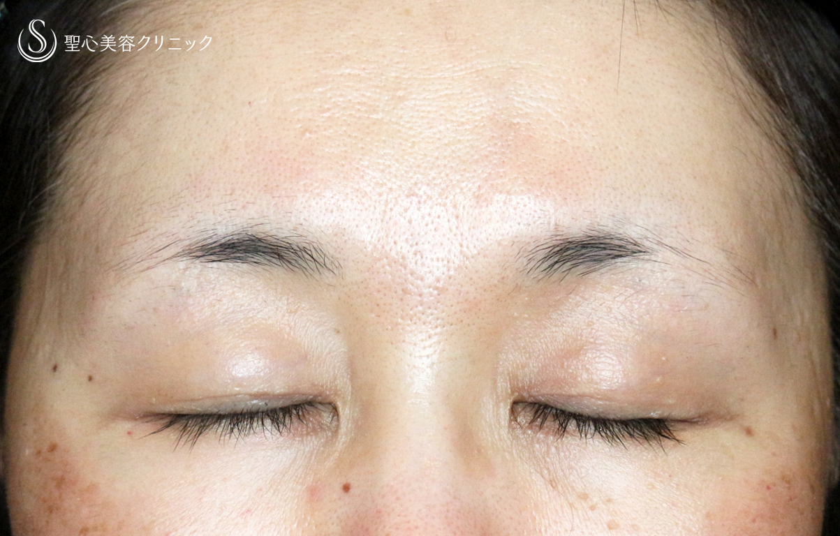 【50代女性・ハードコンタクトレンズ眼瞼下垂】切らない眼瞼下垂+α法（術直後〜1ヶ月後） After 