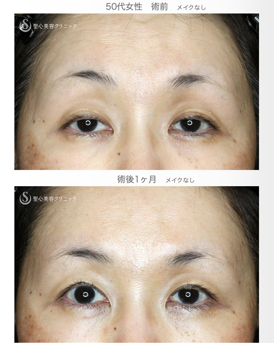 【50代女性・ハードコンタクトレンズ眼瞼下垂】切らない眼瞼下垂+α法（術直後〜1ヶ月後） After 