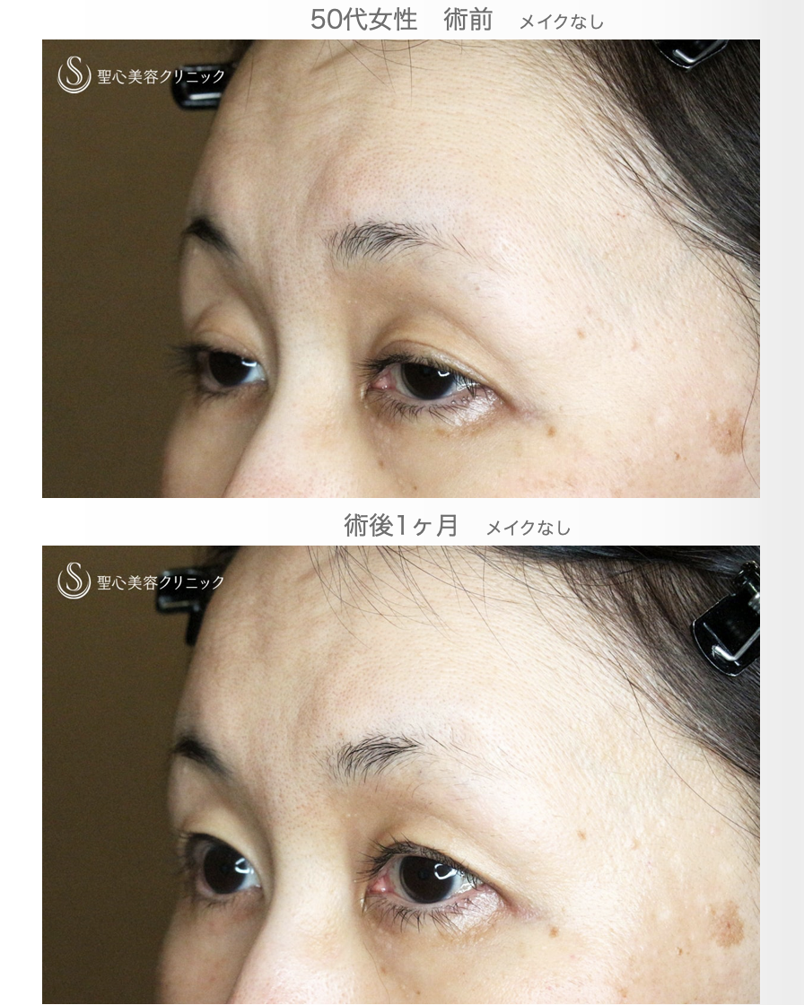 【50代女性・ハードコンタクトレンズ眼瞼下垂】切らない眼瞼下垂+α法（術直後〜1ヶ月後） After 