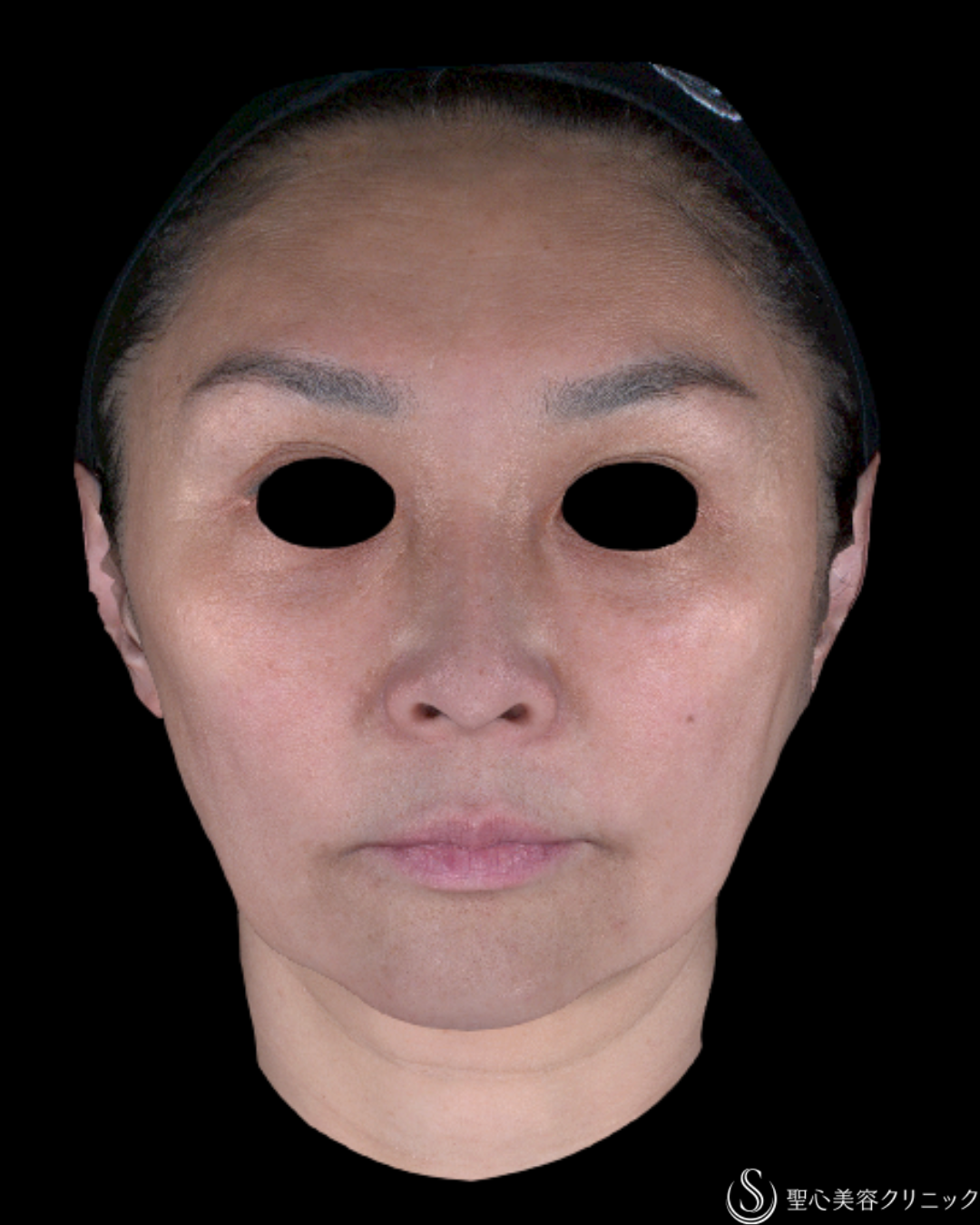 【50代女性・肌育でシワも肌質も色も改善】スキンバイブ（1ヶ月後） Before 