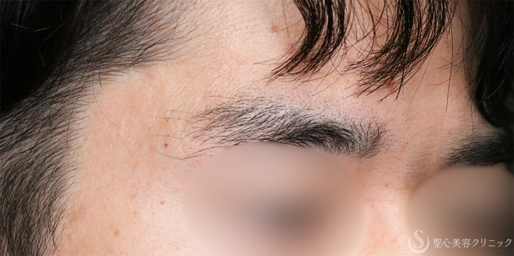 【20代男性・気になるホクロを無くす】ホクロ除去（電気凝固法）（1年後） After 名古屋+ほくろ除去・イボ除去