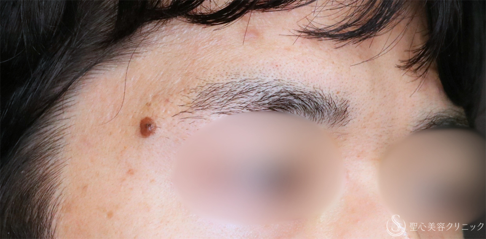 【20代男性・気になるホクロを無くす】ホクロ除去（電気凝固法）（1年後） Before 