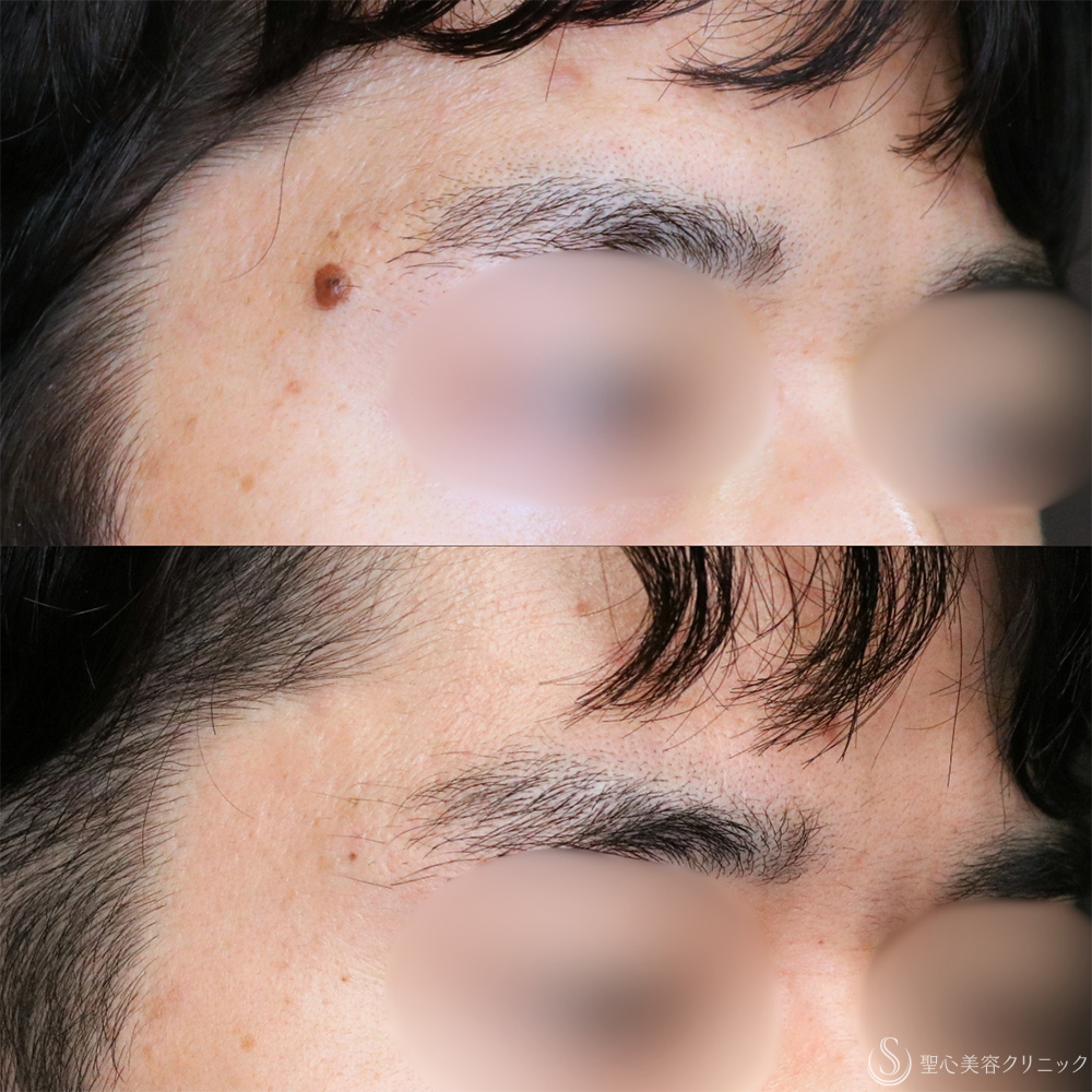 【20代男性・気になるホクロを無くす】ホクロ除去（電気凝固法）（1年後） After 名古屋+ほくろ除去・イボ除去