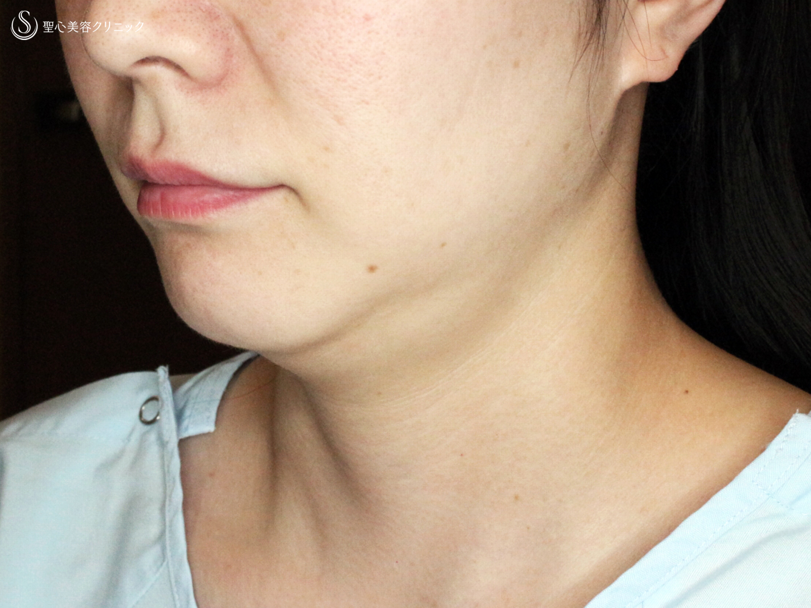 【30代女性・これだけで劇的変化】脂肪吸引注射 あご下（術直後〜1ヶ月後） Before 