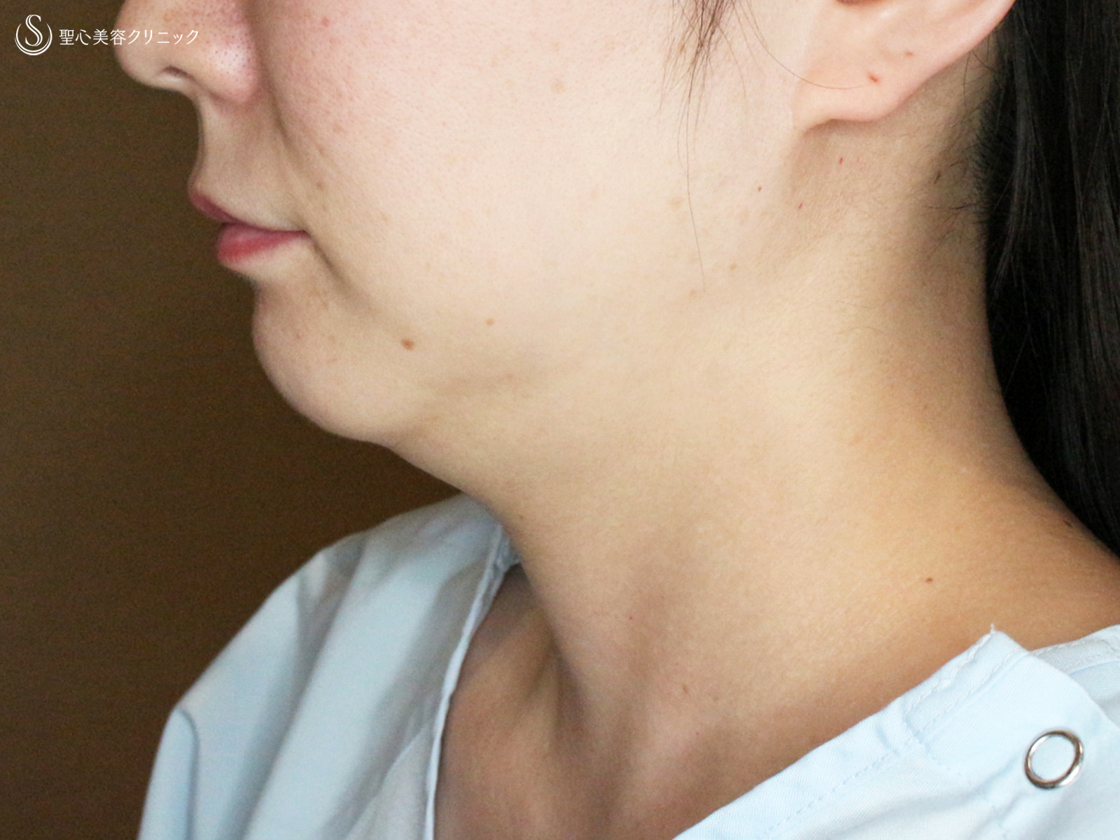 【30代女性・これだけで劇的変化】脂肪吸引注射 あご下（術直後〜1ヶ月後） Before 