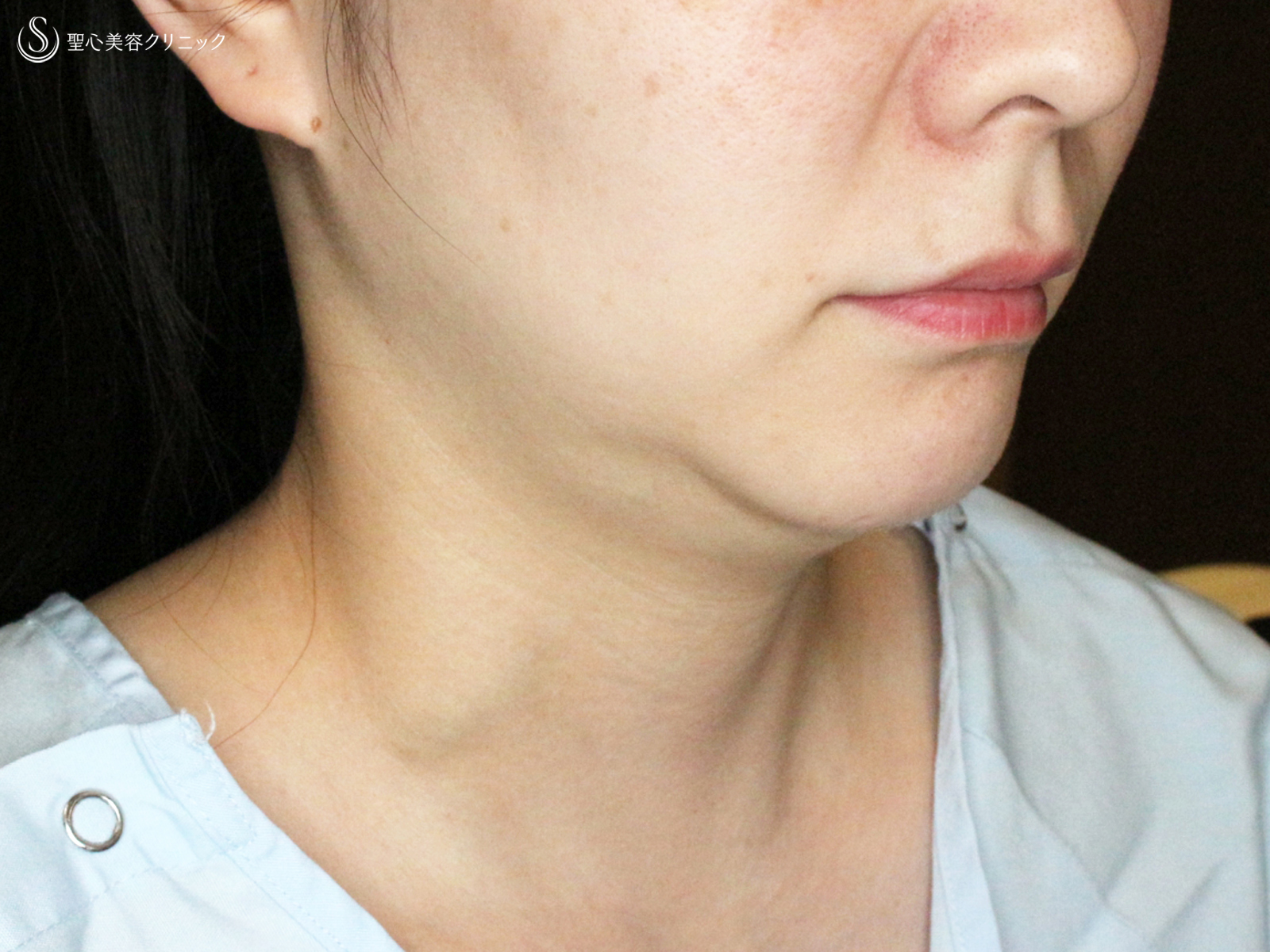 【30代女性・これだけで劇的変化】脂肪吸引注射 あご下（術直後〜1ヶ月後） Before 