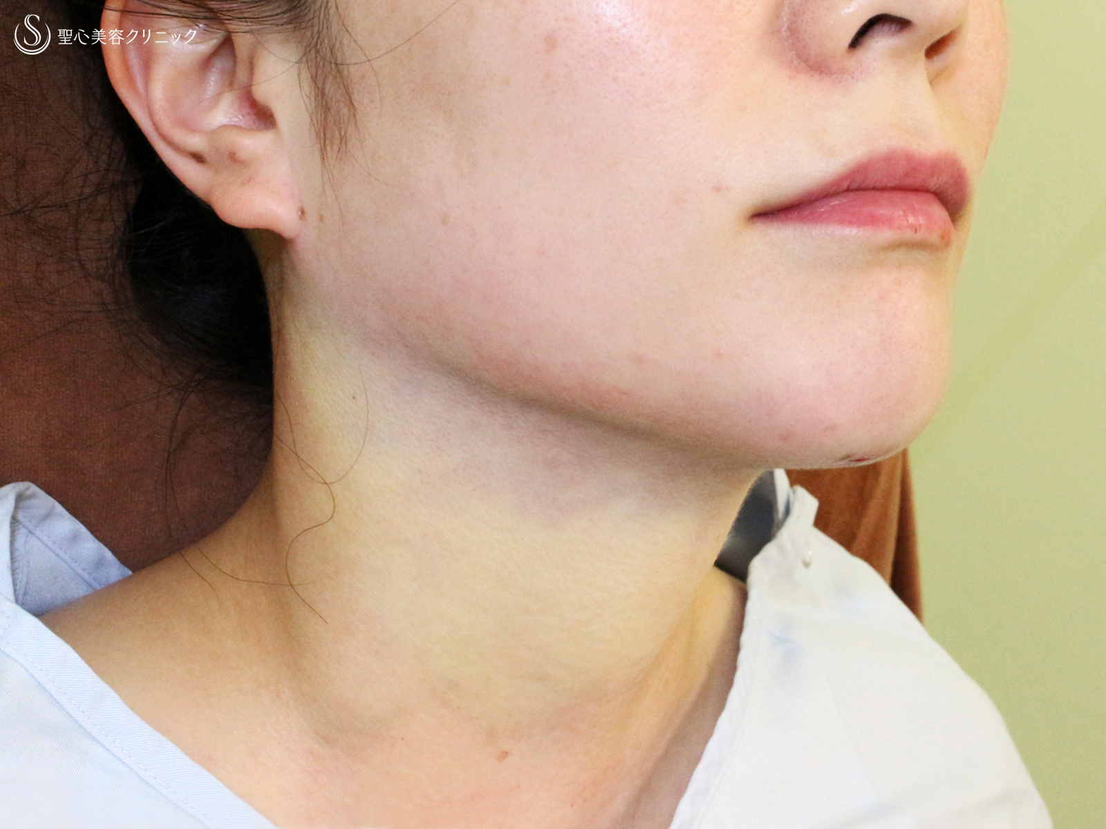 【30代女性・これだけで劇的変化】脂肪吸引注射 あご下（術直後〜1ヶ月後） Before 